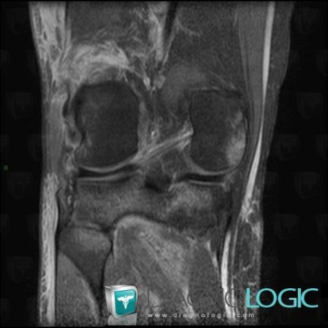 Lateral collateral ligament rupture / Knee, Lateral collateral ligament - Knee, MRI