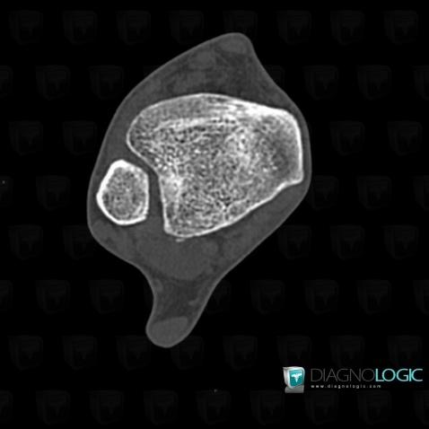 Lateral collateral ligament tear / Ankle, Lateral collateral ligament - Ankle, CT