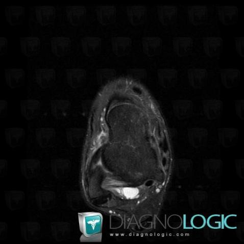 Lateral collateral ligament tear / Ankle, Lateral collateral ligament - Ankle, MRI