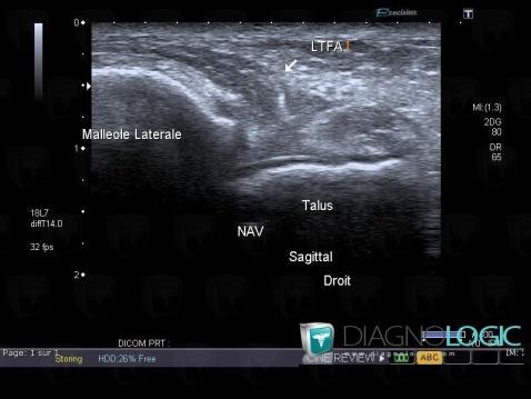 Lateral collateral ligament tear / Ankle, Lateral collateral ligament - Ankle, US