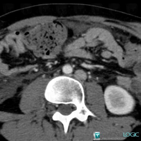 Left inferior vena cava, Inferior vena cava, CT