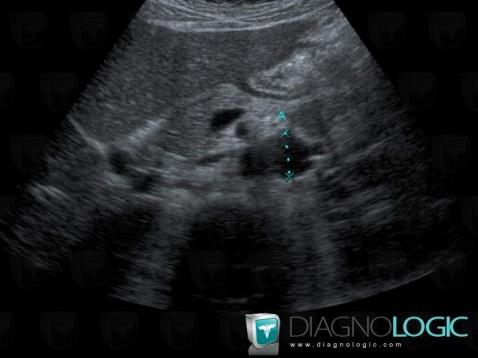 Left inferior vena cava, Inferior vena cava, US