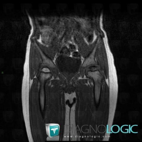 Legg-Perthes disease, Femur - Proximal part, MRI