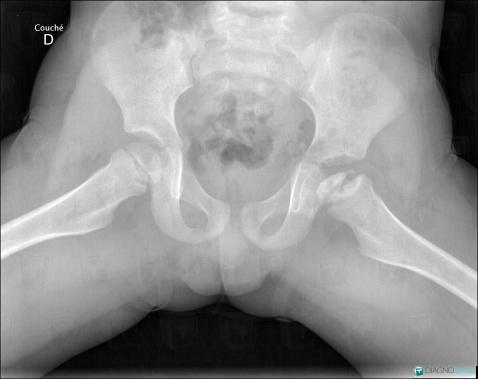 Legg-Perthes disease, Femur - Proximal part, X rays