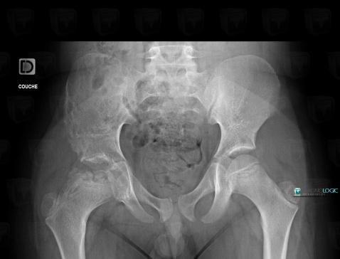 Radiology case : Legg-Perthes disease (X rays) - Diagnologic