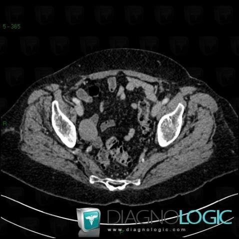 Leiomyoma, Adnexa / Ovary fallopian tube, CT