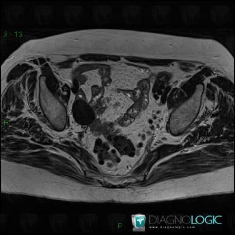 Leiomyoma, Adnexa / Ovary fallopian tube, MRI