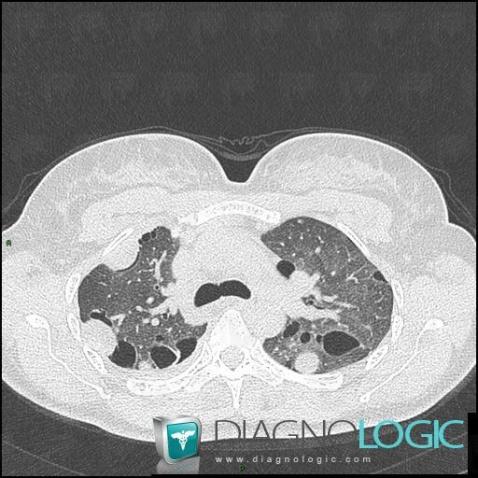 Leiomyoma, Pulmonary parenchyma, CT