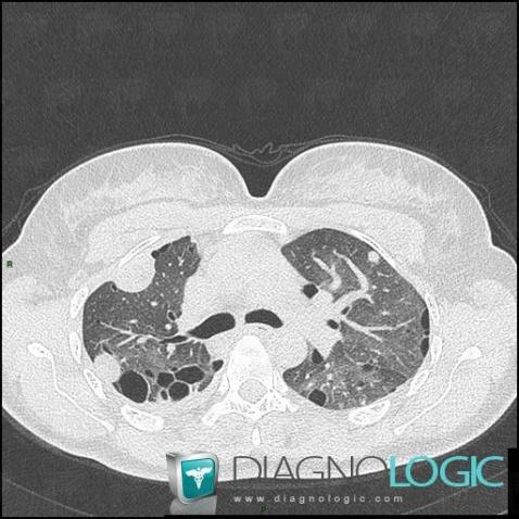 Leiomyoma, Pulmonary parenchyma, CT