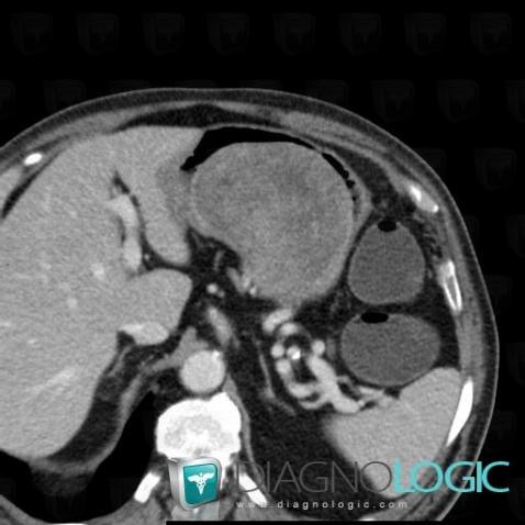 Leiomyoma, Stomach, CT