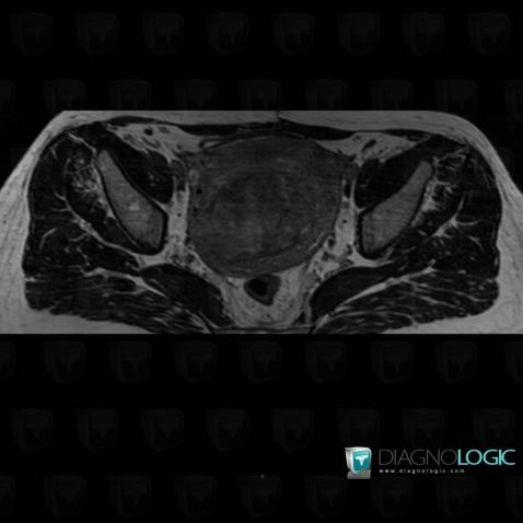 Leiomyoma, Uterus, MRI