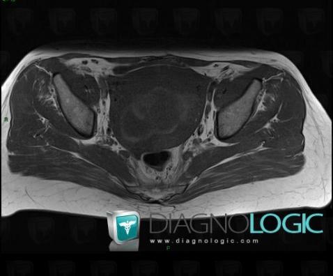 Leiomyoma, Uterus, MRI