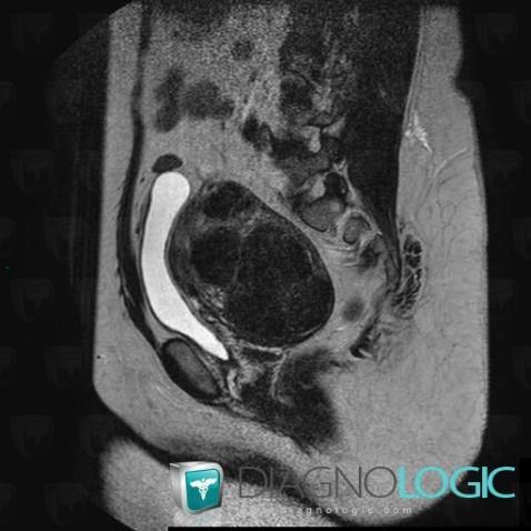 Leiomyoma, Uterus, MRI