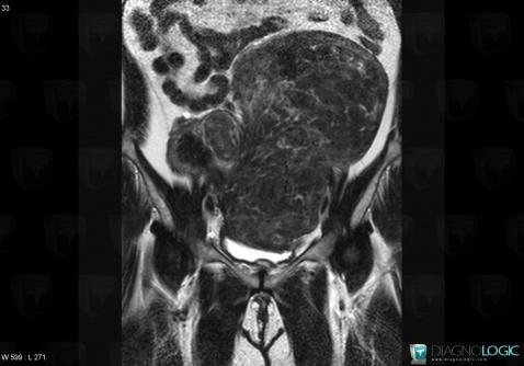 Leiomyoma, Uterus, MRI