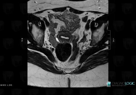 Leiomyoma, Uterus, Pelvis / Perineum, MRI