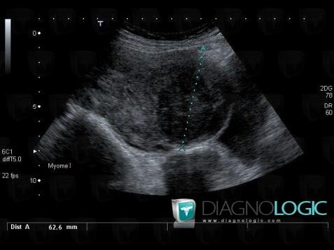 Leiomyoma, Uterus, US