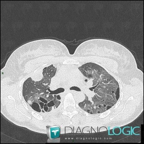 Leiomyomatosis, Pulmonary parenchyma, CT