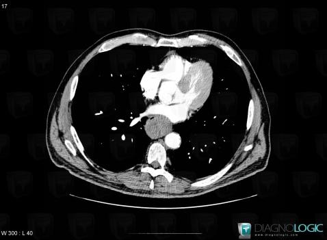 Léiomyome, Oesophage, Scanner
