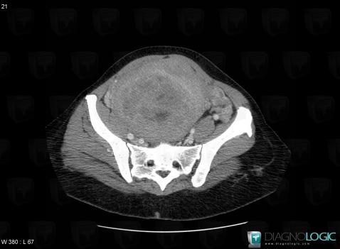 Léiomyome, Pelvis / Périnée, Scanner