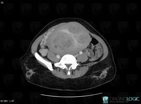 Léiomyome, Utérus, Pelvis / Périnée, Scanner