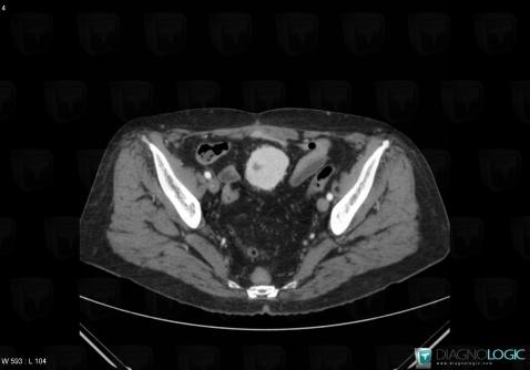 Leiomyosarcoma, Mesentery / Peritoneum, CT