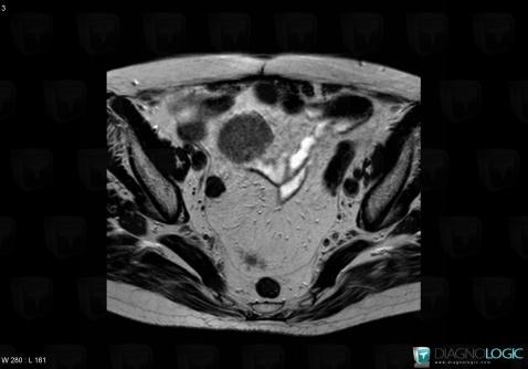 Leiomyosarcoma, Mesentery / Peritoneum, MRI