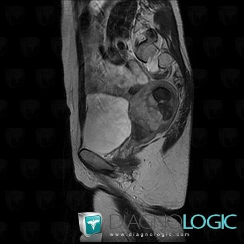 Leiomyosarcoma, Uterus, MRI