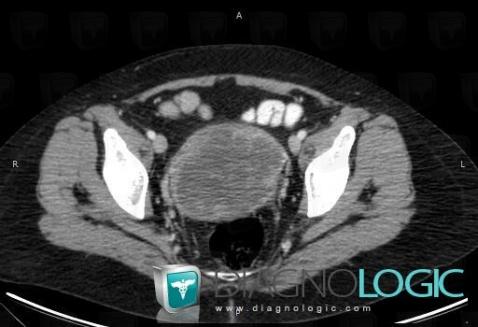 Leiomyosarcoma, Uterus, Pelvis / Perineum, CT