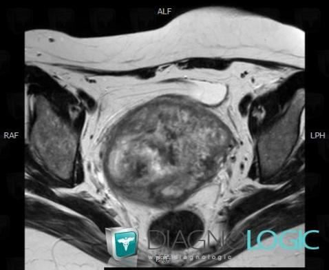 Leiomyosarcoma, Uterus, Pelvis / Perineum, MRI