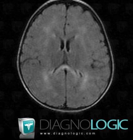 Leucodystrophie métachromatique , Hémisphères cérébraux, Ventricules / Région périventriculaire, IRM