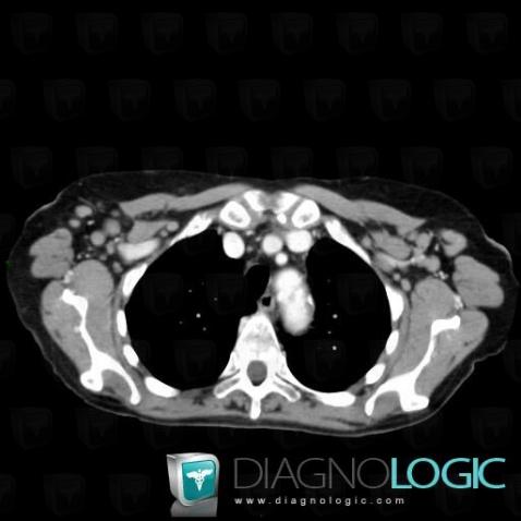 Leukemia, Chest wall, CT