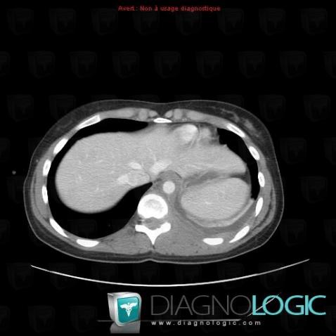 Leukemia, Paraspinal, CT