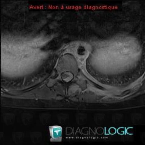 Leukemia, Paraspinal, MRI