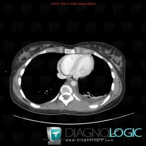 Leukemia, Pleura, CT