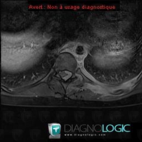 Leukemia, Spinal canal / Cord, MRI