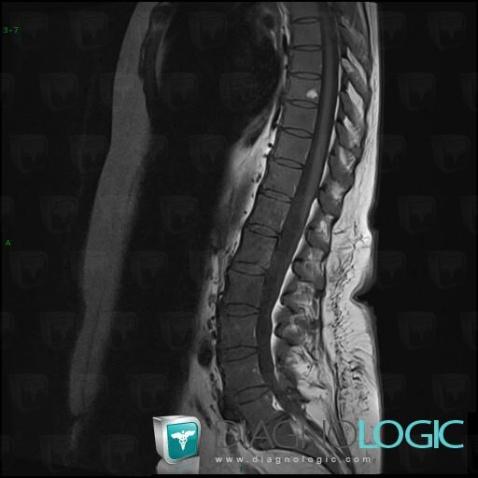 Leukemia, Vertebral body / Disk, MRI