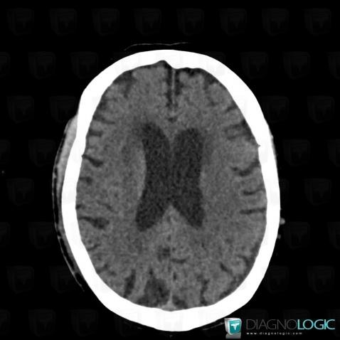 Leukoariaosis, Cerebral hemispheres, Ventricles / Periventricular region, CT