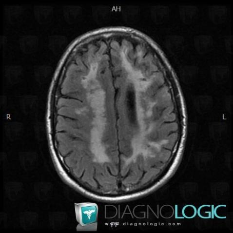 Leukoariaosis, Cerebral hemispheres, Ventricles / Periventricular region, MRI