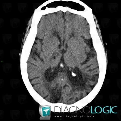 Leukoariaosis, Ventricles / Periventricular region, CT