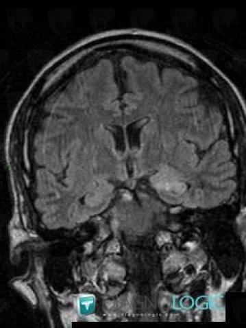 Limbic encephalitis, Cerebral hemispheres, MRI