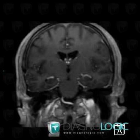 Limbic encephalitis, Cerebral hemispheres, MRI