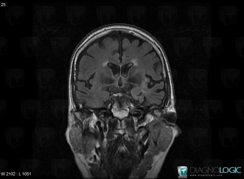 Limbic encephalitis, Cerebral hemispheres, MRI