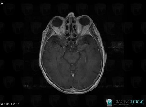 Limbic encephalitis, Cerebral hemispheres, MRI