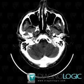 Lipiodol injection, Infratentorial peri cerebral spaces, CT