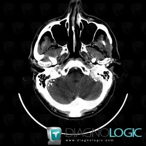 Lipiodol injection, Infratentorial peri cerebral spaces, CT