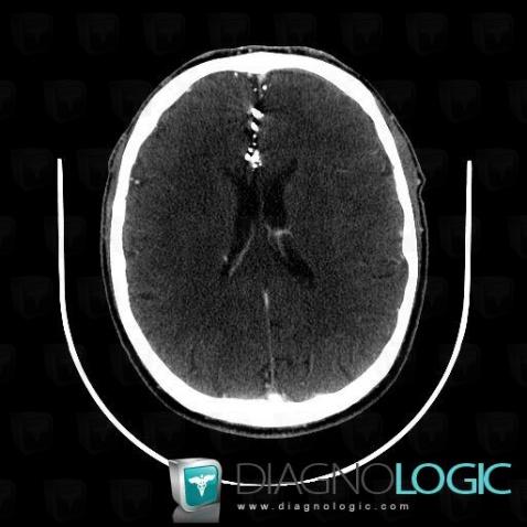 Lipiodol injection, Supratentorial peri cerebral spaces, CT
