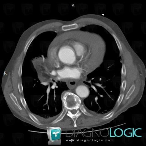 Lipoid pneumonia, Pulmonary parenchyma, CT