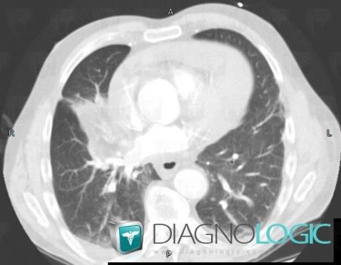 Lipoid pneumonia, Pulmonary parenchyma, CT