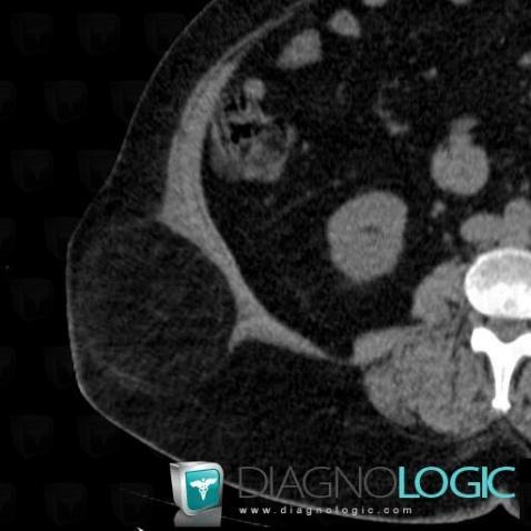 Lipoma, Abdominal wall, CT