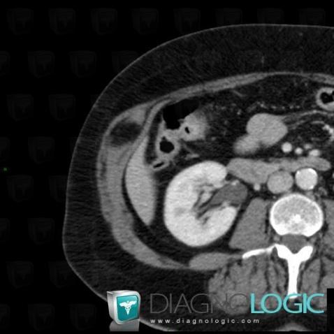 Lipoma, Abdominal wall, CT